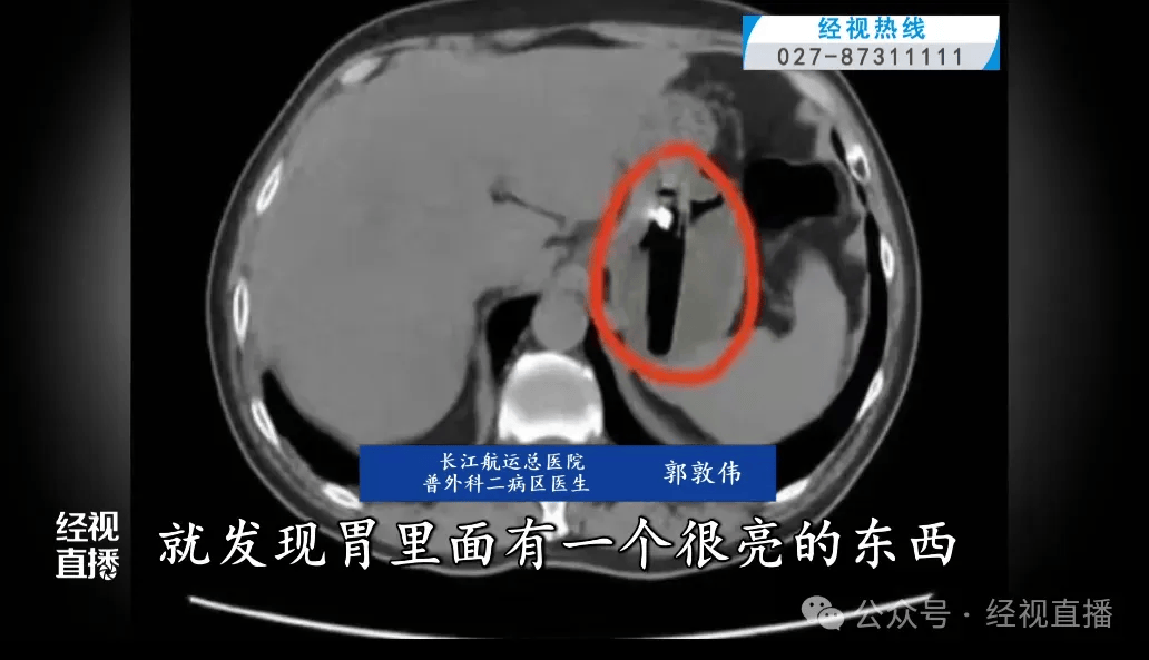 湖北武汉一男子疑酒后吞下一枚长约8厘米打火机，反复摩擦胃窦一个月引发巨大溃疡